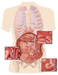 Information About Abdominal Adhesions At Herbal Care Products Abdominal Adhesions Bowel Obstruction Abdominal