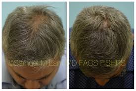Hair takes longer to grow This 46 Year Old Man Shows Early Signs Of Thinning Hair In Particular Toward His Crown Area He Is Shown Dallas Hair Hairstyles For Thin Hair Hair Restoration