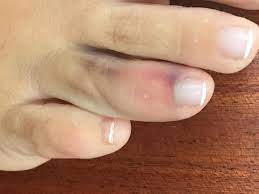 The symptoms include numbness, burning and tingling. Sprained Toe Symptoms Causes And Treatment