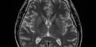 Sclerosis multiple), to przewlekła, zapalna choroba, atakująca układ nerwowy, powodująca uszkodzenie tkanki nerwowej (demielinizacja włókien nerwowych w mózgu). Pddo 2 Obraz Zmian Niespecyficzny Sami Mocni