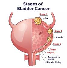 Image result for Bladder Cancer Staging