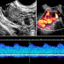 A type of ultrasound in which the device is placed in your vagina. Vaginal Ultrasonography An Overview Sciencedirect Topics