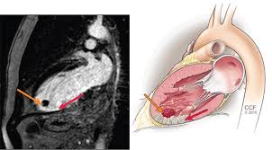 Maybe you would like to learn more about one of these? Left Ventricular Thrombosis Can Still Complicate Acute Myocardial Infarction Cleveland Clinic Journal Of Medicine