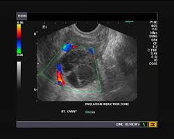 • colour doppler may help in confirming the diagnosis, and in assessing for associated anomalies, particularly in early gestation. A Gallery Of High Resolution Ultrasound Color Doppler 3d Images Ovaries