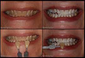 For others, it might take a few days longer to start seeing results. Teeth Whitening Charlotte Cosmetic Dentist Laser Teeth Bleaching