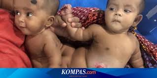 Pertama Kali, Para Dokter Banglades Sukses Pisahkan Bayi Kembar Siam