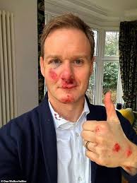 Battered and bruised' Dan Walker says he has 'no memory' of bike crash  after coming to