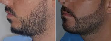 Facial hair transplant for the creation of an attractive beard/moustache coverage. Beard Transplants Miami Fl Dr Anthony Bared