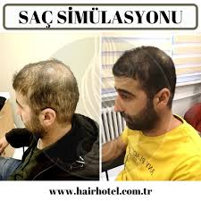 sac simulasyonu sac kadin doktorlar