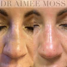 Non surgical Rhinoplasty
