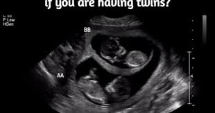 How Early Can They Tell If You Are Having Twins How To Have Twins Twins Twins Ultrasound