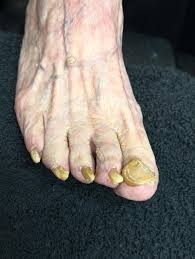 Image result for Onychogryphosis feet