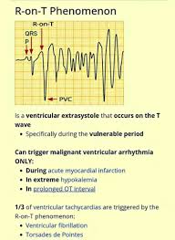 Image result for Extrasystole