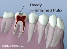 They will clean and fill inside the tooth to prevent this causes irritation, pain and swelling. Root Canal Treatment Montreal Quebec Tooth Saving Endodontic Therapy