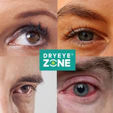 Image result for Dry Eye