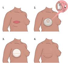 Breast Reconstruction