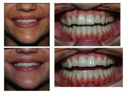 Zahnkronen aus Vollkeramik (Emaxkrone Zirkonoxidkrone)