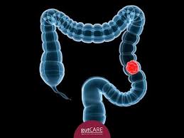 Colon Cancer In Singapore Symptoms Screening Treatments Gutcare