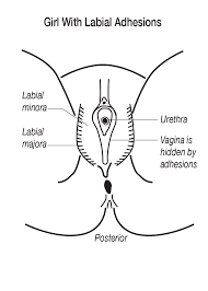 Image result for Labial Fusion