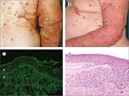 Image result for Pemphigoid