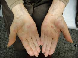 The skin condition, granuloma annulare consists of reddish, raised lesions which tend to form the patterns of ring, mostly in the feet and hands. Granuloma Annulare Of The Palms