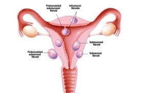 However, they are clinically apparent in up to 25% of all women and cause significant morbidity (disease), including prolonged or heavy menstrual bleeding, pelvic pressure or pain, and, in rare cases. Fibroids Nhs