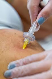 Image result for Trigger Point Injection