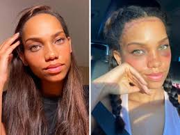 Model undergoes surgery to reduce forehead size