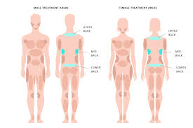 It consists of seven vertebrae. Back Liposuction Procedure Kleinlipo Liposuction Surgery Of Orange County