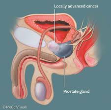 (this is the same for other forms of cancer.) the lymph nodes are a. What Is Localized Or Locally Advanced Prostate Cancer Pcf