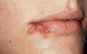 What Causes Mouth Sores Oral Health Aspen Dental