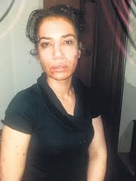 İnternetde sık sık aranan ya da konuşulan konu dilara'nın burnunun estetikli olup olmadığı. Estetik Yaptiran Leyla Demir In Burnu Yamuk Cikinca Takvim