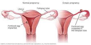 However, emergency medical help is needed if you develop these warning signs or symptoms of an ectopic pregnancy: Ectopic Pregnancy Symptoms And Causes Mayo Clinic
