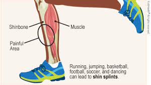 Shin Splints - Johns Hopkins All Children's Hospital
