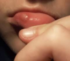 Der knoten ist sehr hart aber schmerzt nur bei druck. Seltsame Beule An Der Lippe Gesundheit Und Medizin