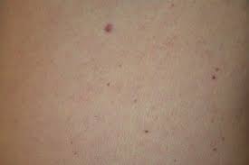For example, keller reported that of hundreds of cases of cherry angiomas, only 2 cases were located on the scalp. Cherry Angioma 21 300 200 Krauss Dermatology