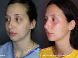 Looking for a way to look refreshed for your upcoming holiday photos? This  is the perfect time to schedule your consult! Submental liposuction is a  procedure performed awake, in the office, with