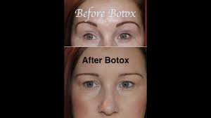 Botox Gone Wrong Before After My Story Youtube