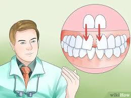 Check spelling or type a new query. Cara Mengetahui Apakah Anda Perlu Memakai Kawat Gigi