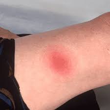 Image result for infected tick bite