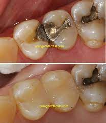 Silver Mercury Amalgam Filling Removal And Replacement Done By Dr Nicholas Calcaterra Of Orange Ct Also Serving Wood Dentist Dental Fillings Dental Services