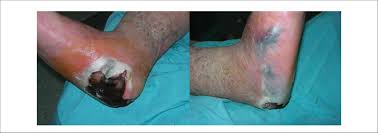 Necrotizing fasciitis is rarely contagious. Necrotizing Fasciitis On The Heel Download Scientific Diagram
