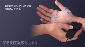 Diagnosing Carpal Tunnel Syndrome