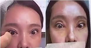 Combined surgery is the main specialty of the clinic. Woman Unable To Fully Close Her Eyes After Botched Double Eyelid Surgery