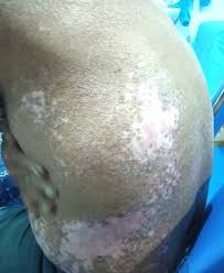 Image result for Postinflammatory Hypopigmentation