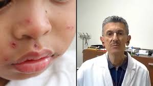 Measles outbreak in Texas highlights vaccine importance, says El Paso expert