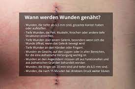 Musik, die in ihren ohren wundervoll klingt kann für ihren nachbarn eine qual sein. Wann Wird Eine Wunde Vernaht Und Wann Nicht