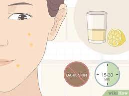 3 Ways To Get Rid Of Acne Redness Fast - Wikihow