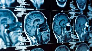 Headaches that get worse over time are a common symptom of brain tumors. Which Symptoms Point To Brain Tumors In Children