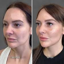Albuquerque Full Face Balancing Before & After: Chrome Aesthetics